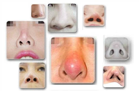 Các biến chứng thường gặp sau khi phẫu thuật nâng mũi