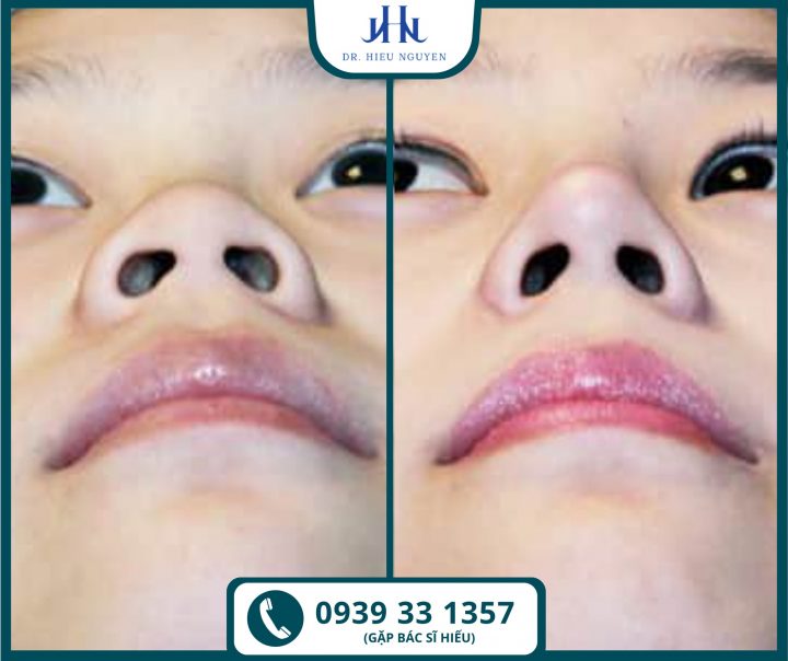 Hình ảnh khách hàng trước và sau khi phẫu thuật nâng mũi