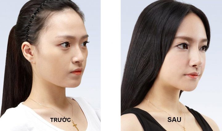 Hình ảnh khách hàng trước và sau khi nâng mũi