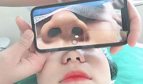 Dùng phương pháp phẫu thuật thu nhỏ lỗ mũi