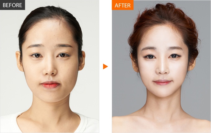 Hình ảnh trước và sau khi thực hiện phẫu thuật độn cằm